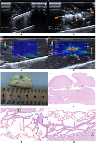 Figure 1. Ultrasound and pathological findings.Note: A. Ultrasound guided microwave antenna insertion into ex vivo brain tissue； B. Hyperechoic (arrows) area gradually observed with slow enlargement over time. USL1 and USL2 are the maximum diameters that can be measured along the antenna insertion channel, and USL2 is perpendicular to USL1; C. SWE images of normal brain tissue; D. SWE image of microwave ablation area; E. Cross macroscopic images of ablation; F. Microscopic pathology after H&E staining. Section of with a well-demarcated area of coagulation necrosis; G. corresponded to green box 1 on Figure F; H. corresponded to green box 2 on Figure F