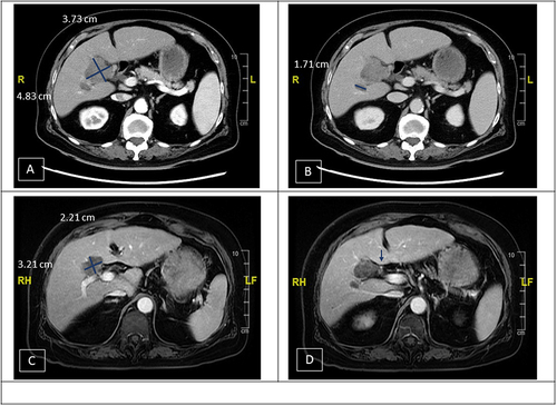 Figure 1 Imaging studies before and after ICI therapy. (A and B) A 4.83×3.73 cm hypervascular mass at liver S5. The mass had invaded her gallbladder and encased the right hepatic artery. (A) Arterial phase, (B) delayed phase; (C and D) after nivolumab, the tumor decreased from 4.83 cm to 3.21 cm (>30% reduction). The major vessels including right hepatic artery were spared from tumor invasion. (C) Arterial phase, (D) delayed phase.