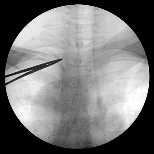 Figure 5 Needle insertion point is directed with tip of curved forcep at the lower left angle of T1 vertebrae.