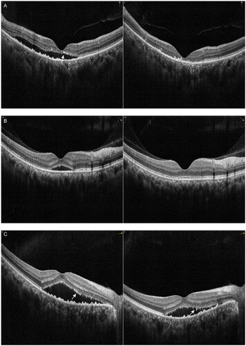 Figure 2. Examples of the change in serous subretinal fluid (SRF) with spectral domain optical coherence tomography (SD-OCT) in patients with chronic central serous chorioretinopathy (cCSC) after intravitreal injections with aflibercept (IVA). The left panel represents SD-OCT B-scan images at baseline visit, the right panel represents SD-OCT B-scan images at one-month follow-up visit after IVA. (A) SD-OCT B-scan at baseline showed sub-macular SRF and irregularly appeared RPE from the right eye of a 65-year-old male patient (left). Hyperreflective foci (HFs) are visible between the ellipsoid zone and RPE (arrow). At the one-month visit after IVA treatment, SRF were resolved, however, disruptions in the ellipsoid zone remained (right). (B) SD-OCT B-scan at baseline showed sub-macular SRF from the right eye of a 49-year-old male patient (left). At the one-month visit after IVA treatment, SRF were completely resolved, the ellipsoid zone and RPE are intact (right). (C) SD-OCT B-scan at baseline showed presence of SRF and irregularly appeared RPE from the right eye of a 56-year-old male patient (left). The HFs are visible between the ellipsoid zone and RPE (arrow). At the one-month visit after IVA treatment, SRF were partially resolved. The presence of HFs remained, with disruptions in the ellipsoid zone and irregularly thickened RPE (right).