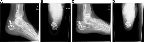 Figure 4 (A) The postoperative X-ray lateral radiograph, the displaced fracture was reset again after revision, and the mini-locking plate was fixed in a 180-degree ring. (B) Postoperative axial X-ray of the case, the fractured piece was reliably fixed by the micro locking plate. (C) The X-ray lateral radiograph one year after the operation, the displaced fracture has been reset and achieved bony union, and the mini-locking plate was fixed in a 180-degree ring without loosening and displacement. (D) Axial X-ray one year after surgery, the fracture has reached bone union.