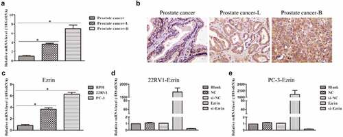 Figure 1. Expression of Ezrin in prostate cancer tissues and cell lines. (a) The Ezrin expression in different stages of PCa was determined by qRT-PCR. *P < 0.05. (b) IHC staining of Ezrin was performed on PCa tissues at different stages. (c) The relative expression of Ezrin in different PCa cell lines. *P < 0.05. (d) 22RV1 cells were transfected with different plasmids to evaluate the Ezrin expression with qRT-PCR. (e) Different plasmids were transfected to PC-3 cells to assess the Ezrin expression using qRT-PCR.