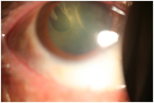 Figure 1 Slit-lamp biomicroscopy photograph showing a retinal detachment behind the crystalline lens associated with a superotemporal horseshoe tear.