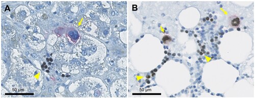 Figure 3 . Immunohistochemical examination of the liver biopsy specimen and positive control. (A) Double-immunostaining shows that GATA1 is negative in the nuclei of CD42b-positive megakaryocytes (arrow), but positive in the nuclei of erythroblasts found in erythroblastic islands within the liver (arrowhead). (B) Double-immunostaining of the normal bone marrow, as a positive control, shows that GATA1 is positive in the nuclei of CD42b-positive megakaryocytes as well as in the nuclei of background erythroblasts.