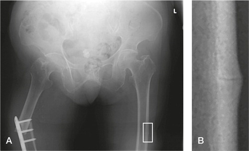 Figure 4. Patient 10. A. A transverse fracture through the top-most screw hole of the right femur plate shows minimal comminution. The native left femur shows lateral cortical thickening (box). B. The “dreaded black line” can be seen in the area of cortical thickening in this magnified image of the left femur shaft.