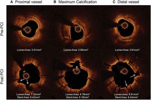 Figure 4. OCT images pre and post-IVL of a severely calcified lesion. Calcium fractures, identified with white arrows in the post-PCI images above, allow for optimal stent expansion [Citation26].