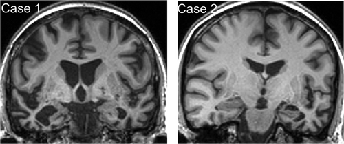 Figure 1. Brain MRI profiles in patients with semantic dementia and food aversion.Representative coronal T1-weighted MR sections through the anterior temporal lobes are presented for each of the patients described; the left hemisphere is shown on the right for both sections. In each case, there is relatively focal, asymmetric atrophy of the anterior temporal lobes, most marked medially and inferiorly (predominantly right-sided though bilateral in Case 1, predominantly left-sided in Case 2).