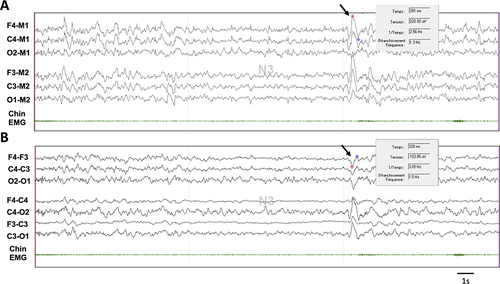 Figure 2 Peak-to-peak amplitude of slow waves according to different EEG montages. This N3 epoch is shown with the AASM recommended referential montage (A) and in a bipolar montage (B) with transverse (up) and longitudinal (down) channels. Both panels are visualized with an amplitude of 10µV/mm for EEG channels. The peak-to-peak amplitude of the same slow wave is measured on two different channels (black arrow). The amplitude is higher using the AASM recommended montage on the frontal channel (220.92 µV in (A) compared to the transverse montage (−103.85 µV in (B) with a negative value due to the inverse polarity). Also note that in (B) the maximal amplitude of this slow wave is not in observed frontal channels.