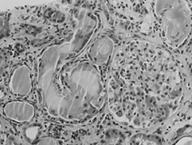 Figure 1. Large and fragmented tubular casts associated with histiocytes or multinucleated giant cells are present (center and upper right). Two nonspecific hyalin casts are seen (left). A glomerulus shows only mild mesangial sclerosis (hemotoxylin & eosin, original magnification × 400).
