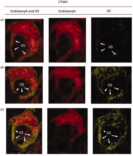 Figure 5. The image score of injured level of canalolithiasis defined with the amount of OS. (A) Level +1: small amount OS (yellow color) can be somewhat visible with two CTWVS of endolymph (red color) and OS (yellow color), but scarcely visible only with single CTWV of OS. (B) Level +2: condition between level +1 and level +3. The existing OS (yellow color) can also be visible with CTWV of OS. (C) Level +3: so much OS like a jammed aspect, in the HC lumen where the endolymph is very small. CTWV: CT window value; HC: horizontal canal; OS: otoconia-like substance.