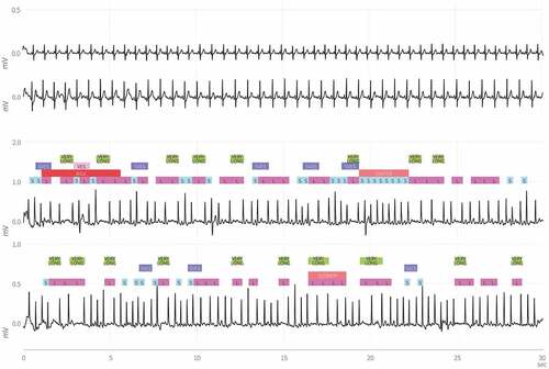 Figure 2. Chest-and thumb registrations during sinus rhythm and atrial fibrillation. Permission to use approved by Coala Life AB.