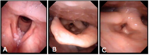 Figure 3. The patient underwent radiotherapy after surgery. (A) Preoperative endoscopy of larynx shows the location of tumor in the right vocal fold, anterior commissure, and anterior 1/3 of the left vocal fold. (B) Endoscopy at 3 months after surgery shows that the mucosa of the larynx has been healed well. The shape of laryngeal cavity is roughly normal. (C) Endoscopy at 3 months after surgery shows an approximately normal activity of the left vocal fold.