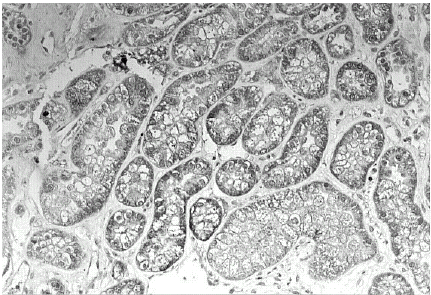 Figure 2. Immunohistochemical detection of TGF-β1 within the cytoplasm of tubular epithelial cells (dark areas) in transplanted kidney sections.