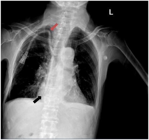 Figure 1. Ultrasound-guided group required postoperative chest X-rays for review. Red arrows indicate the occurrence of kinked catheter events, while the black arrows indicate the position of the catheter tip.
