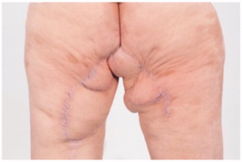 Figure 5. 6 months post-operative result.