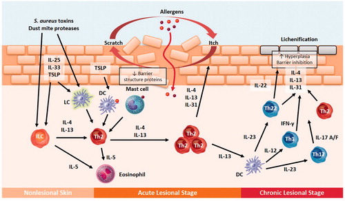 Figure 1. Skin barrier dysfunction and immune response in atopic dermatitis (AD). DC: dendritic cell; IFN-γ: interferon gamma; ILC: innate lymphoid cell; IL: interleukin; IL-17 A/F: IL-17 A/F homodimer or heterodimer; LC: Langerhans cell; Th1: T helper type 1 cell; Th17: T helper type 17 cell; Th2: T helper type 2 cell; Th22: T helper type 22 cell; TSLP: thymic stromal lymphopoietin.