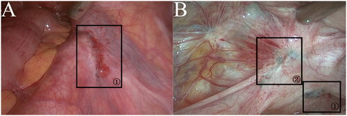 Figure 1. (a)DIE in the right anterior ureter. (b) PEM and DIE in the left sacral ligament.Morphological features of PEM and DIE: (a) DIE in the right anterior ureter that morphologically behaved similarly to the brown lesions of PEM under laparoscopy; however, compared to PEM, the lesion was found to have infiltrated deeper into the subperitoneum during resection. The histopathology confirmed that it was DIE. (b)Marker ① indicated a brown lesion in the left sacral ligament, with visible pigmentation and no obvious vascular aggregation in the surrounding peritoneum. (b) marker ② indicated DIE in the left sacral ligament, with obvious vascular aggregation and a crinkled spasm in the surrounding peritoneum.