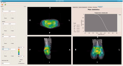 Figure 3. Screenshot of the graphical user interface for on-line use of hyperthermia treatment planning. Phase-amplitude settings can be adapted on the left hand-side. The corresponding predicted temperature distribution is instantly projected onto the CT scan. In the top right window the temperature volume histogram of the delineated target region is shown, with a summary of the indexed temperatures T10, T50 and T90 and minimum and maximum temperature.