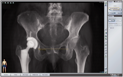 Figure 3. Measurement of the inter-teardrop distance (ITD). The measurement was performed virtually based on digitally reconstructed radiographs (DRRs) with iPlan 3.1 prototype software (Brainlab AG).