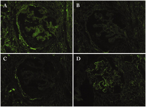 Figure 5. Immunofluorescence findings of the glomerulus in a patient with IgG4-related membranous glomerulonephritis. (A) IgG1; (B) IgG2; (C) IgG3; (D) IgG4.