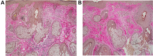 Figure 6 (A and B) Biopsies of subject treated with bland moisturizer pretreatment and at 90 days post treatment. Elastic fibers disappear after treatment with an early re-appearance in reticular dermis at 90 days after treatment.