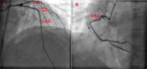 Figure 2 Coronary angiographic views of the patient.