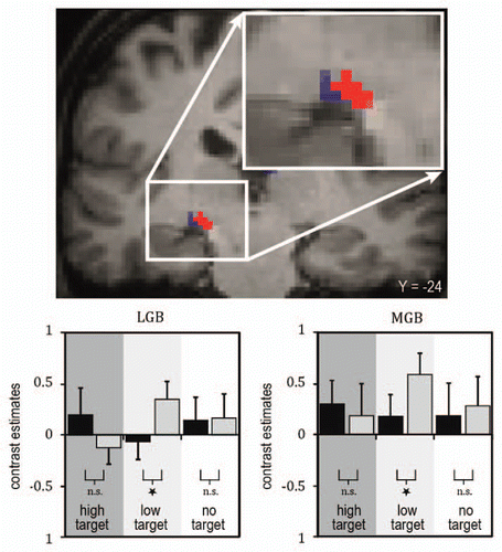 Figure 1 Illustration of fMRI BOLD (blood oxygen level dependent) responses in subject-specific visual and auditory thalamus (adapted from Noesselt et al.Citation53). Top: Brain section depicts visual (LGB, blue) and auditory (MGB, red) thalamus for one illustrative individual subject (for more details see Noesselt et al.Citation53). The bar graphs below of the brain sections depict the height of the fMRI-signal for the experimental conditions deduced from subject-specific ROIs (region of interest; see bar graphs, with grey bars for sound conditions and black for no-sound for the three visual stimuli: high intensity, low intensity, no visual target). An enhanced fMRI-signal was found when a sound was added to a lower-intensity visual target, but no significant change in response when the same sound was added to a higher-intensity visual target in accord with the behavioral findings.