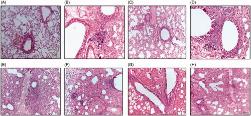 Figure 4. A photomicrograph of lung sections of control group (A) showing normal epithelization of bronchi and bronchioles with normal alveoli and normal configuration of thymus; (B) urethane-treated mice exhibiting foccal aggregation of neoplastic epithelial cells around the bronchioles and marked pleomorphic and advanced mitotic activities; (C) GNPs-treated mice showing few peribronchial proliferations of fibroblast cells and hemolysis of blood vessels; (D) Mice treated with LGNPs showing few peribronchial proliferations of fibroblast cells together with few lymphocytes and macrophages and hemolysis of blood vessels; (E) treated with Urethane + GNPs demonstrating few peribronchial and perivascular aggregation of neoplastic cells and severe proliferation of pneumocytes and occlusion of air alveoli and slightly hemolysis of blood vessels; (F) lung sections from mice treated with urethane + LGNPs exhibiting group of parabronchial aggregation of neoplastic cells with marked pleomorphic and advanced mitotic activities and notice congestion and edema in the alveoli; (G) lung section from mice animals treated with Urethane + TGNPs showing hyperplasia of bronchial epithelial cells and severe hemolysis of blood vessels with mild proliferation of pneumocytes among alveoli; (H) lung section from animal treated with urethane + LTGNPs display paravascular aggregation of lymphocytes and few fibroblast cells and hyperplasia of bronchial epithelial cells and marked alveolar edema with hemolysis in blood vessels. (H&E X 200).