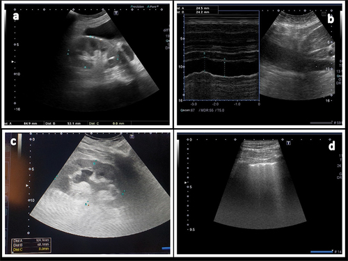 Figure 1. Different POCUS findings: (a) short hyperechogenic right kidney reflecting CKD; (b) B and M modes of IVC assessment show plethoric IVC; (c) hyperechogenic kidney with moderate degree of hydronephrosis; (d) lung ultrasound shows lung congestion (B lines).