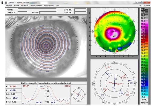 Figure 2 (A) Videokeratographic map of the right eye of a 19-year-old male patient before treatment. The topographic pattern highlights the keratoconus appearance. The apex of ectasia power (in the central side of the cornea) is 68.7 D (relative scale, tangential algorithm). (B) Right eye videokeratographic map 12 months after transepithelial corneal collagen cross-linking with riboflavin and ultraviolet A irradiation.