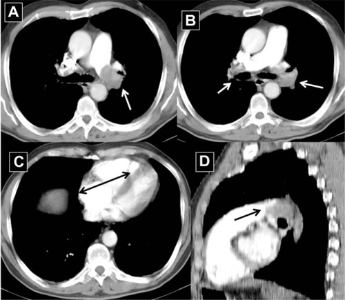 Figure 4 A 58-year-old man admitted to hospital with acute dyspnea, hypotension, and hypoxia (arrows).