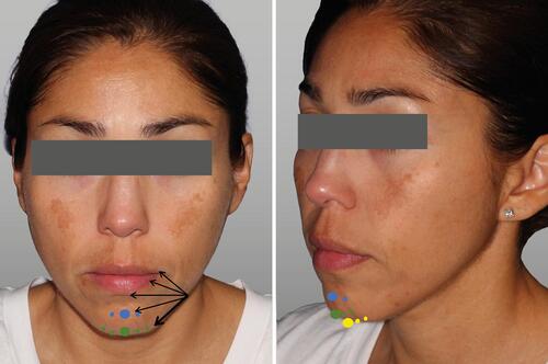 Figure 12 Marionette lines – injection technique. Arrows represent linear retrograde strands of dermal filler and circles represent boluses. Courtesy of Sabrina Fabi, MD.
