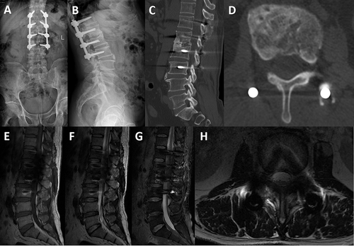 Figure 4 Typical cases of perioperative triple chemotherapy. X-ray 3 months postoperatively: firm internal fixation without loosening (A and B); CT 3 months postoperatively: bony fusion occurred, and the bone of the lesion was repaired obviously than before (C and D); MRI 3 months postoperatively: the diseased intervertebral disc and its adjacent soft tissue were repaired well (E–H).