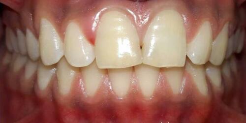 Figure 4 Photograph after completion of bleaching procedures.