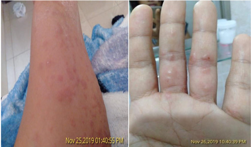 Figure 2 Rash and itching on the anterior surface of the left arm and hand, which the patient felt worsen.