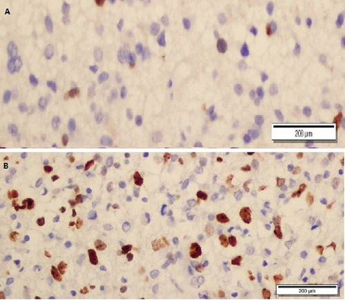 Figure 2. Ki-67-stained, low-grade (A) and high-grade (B) glial tumour (x400).