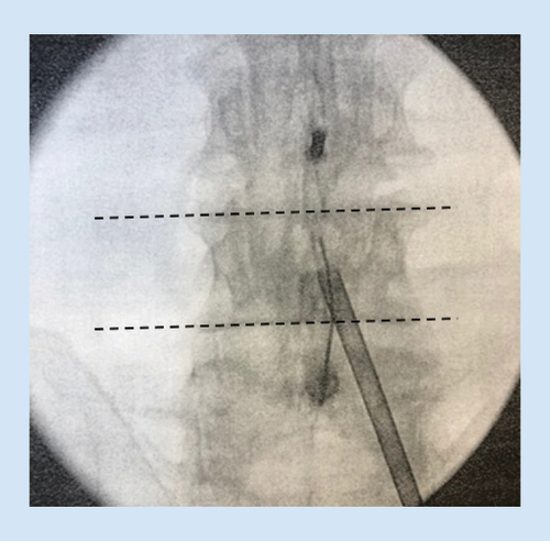 Figure 4. An AP image with the vertebral endplates squared with the fluoroscopic beam is recommended to evaluate the interlaminar space.