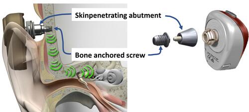 Figure 1 The Ponto® system (left) snapping to the outside and the Baha® system (right) snapping to the inside of the skin penetrating abutments that are attached to similar osseointegrated bone-anchored screws.