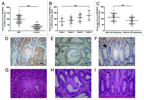 Figure 1. TMPRSS4 was highly expressed in CRC tissues. The mRNA expression level of TMPRSS4 in: (A) CRC tissues and normal mucosa; (B) different stage CRC tissues; and (C) CRCs with and without LN metastases. Immunohistochemical staining of TMPRSS4 (in brown) in: (D) stage IV CRC; (E) stage I CRC; and (F) normal mucosa. (G–I) are the matched HE staining of (D–F). (Scale bars: 100 μm. **P < 0.01)