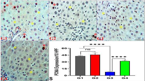 Figure 4 Effect of garlic extract on trastuzumab-induced PCNA expression in the liver tissues. Liver tissues of G1 and G2 show normal hepatic architecture of hepatocytes (yellow stars) and some hepatocytes with obvious PCNA IE of mitotic brown nuclei (red stars). In contrast, the liver tissues of G3 shows hepatocytes without PCNA IE (yellow stars) and G4 exhibits normal hepatic architecture (yellow stars) with PCNA IE of brown nuclei in some hepatocytes (red stars). PCNA immunostaining, 200x, bar =100 µm. (S) Quantitative analysis of PCNA IE area %/10 HPF. nsNo significance between G1 vs G2, ****Significance difference G1, G2 vs G3, and G3 vs G4 (p<0.001).