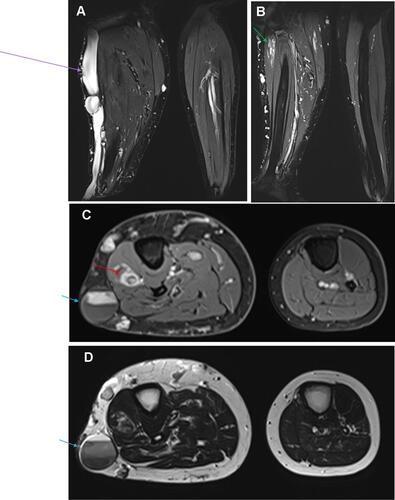 Figure 3 Composite figure illustrating: (A and B) Coronal T2 weighted-images with fat saturation showing severely dysplastic and ectatic subcutaneous vein (purple arrow) situated on the lateral aspect of the right leg, which is draining a complex circumferential network of subcutaneous varices and is associated with venostasis. Additionally, intramuscular ectatic deep veins with slow flow venous malformation seated in the proximal part of the deep posterior compartment (green arrow). (C) Axial contrast-enhanced T1 weighted image with fat saturation and (D) Axial T2 weighted-image demonstrate asymmetric hypertrophy of the right leg subcutaneous soft tissue and muscles as well comparing to the normal contralateral side. Furthermore, an intramuscular cavernous hemangioma (red arrow) is seen seated in the proximal part of the extensor digitorum muscle of the right calf. We can note a slow and delayed opacification of the large subcutaneous vein on the post-contrast image. Venostasis is demonstrated by a multilayer of spontaneous contrast (blue arrow).