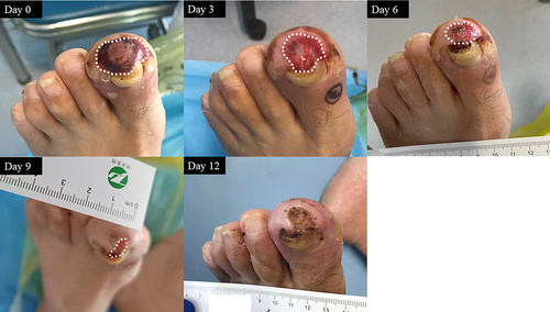 Figure 1 Representative images of the healing process in case 1.