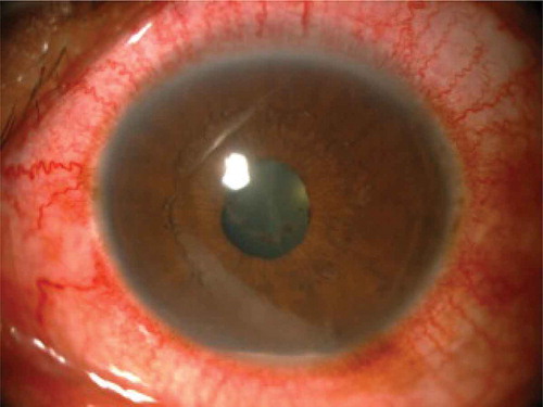 FIGURE 1. Conjunctival and perilimbal redness with fibrinous reaction seen in the pupil and hypopyon in patient with HLA-B27-associated AU