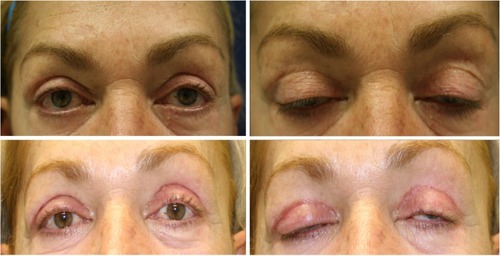 Figure 1 Eyelid appearance and scar in a representative patient.