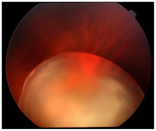 Figure 4 Preoperative ocular fundus examination of the right eye in case 2.