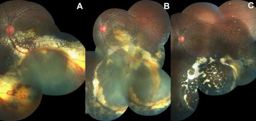Figure 2 Colored fundus photographs of the left eye in a 13-year-old female patient with stage 3A disease. (A) Initial presentation (CDVA: 20/100, 0.2), (B) follow-up 1 month following intervention with incomplete resolution of SRF, and (C) final follow-up after 13 months with complete resolution of SRF and telangiectasia, and marked reduction in exudate density (CDVA: 20/50, 0.4). Intervention was repeated once and consisted of laser ablation therapy and intravitreal ranibizumab.