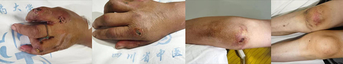 Figure 4 Patient’s skin condition on 2023-07-06.