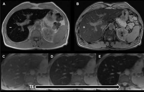 Figure 14 MRI showing iron overload.