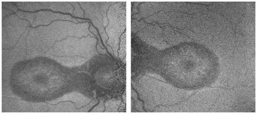 Figure 4 Right and left fundus autofluorescence imaging showing clearly defined hypofluorescent areas in the peripapillary regions that extend along the macula, with a sleep mask appearance.