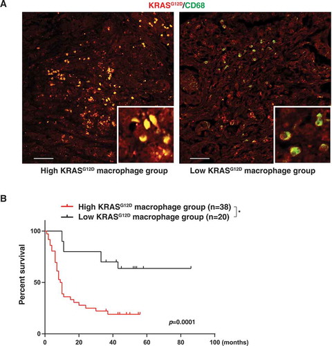 Figure 5. High KRASG12D expression in macrophages correlates with poor survival in PDAC patients. (A) Representative images of KRASG12D (red) and CD68 (green) staining in PDAC tissues. Bar: 100 µm. (B) Comparative survival analysis of KRASG12D expression in macrophages in PDAC patients (*P = 0.0001, log-rank test)